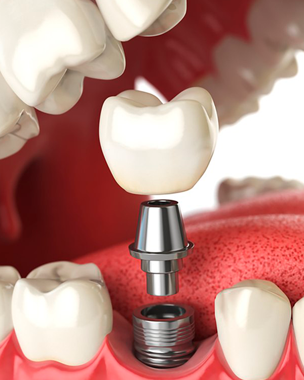Procedimento de implante dentário